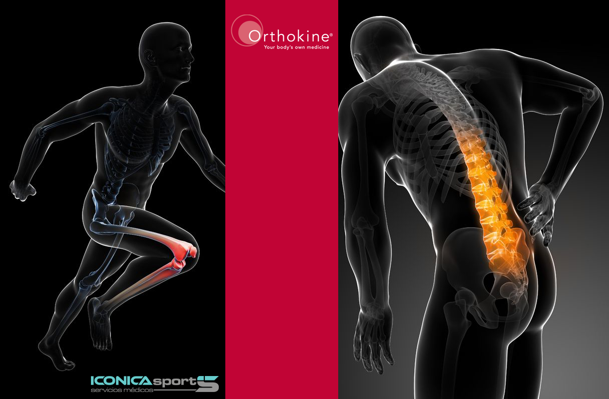 tratamiento-orthokine-para-artrosisi-en-vigo-galicia