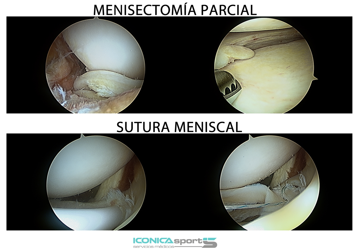 artroscopia-menisectomia-parcial-sutura-de-menisco