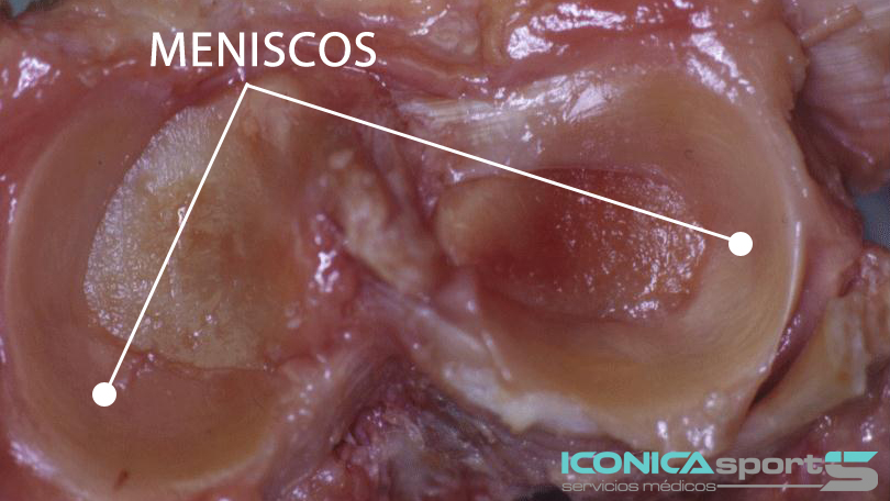 tratamiento rotura de menisco