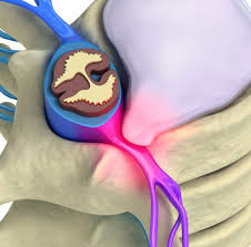 hernia-discal-clinica-iconica-sports-vigo