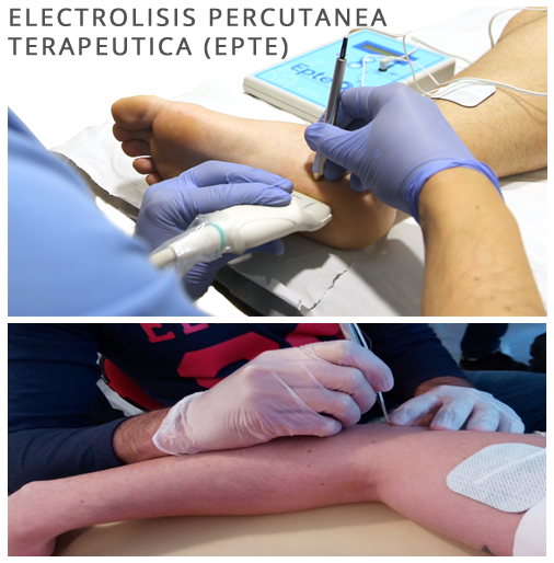 ELECTROLISIS-PERCUTANEA-TERAPEUTICA-(EPTE)