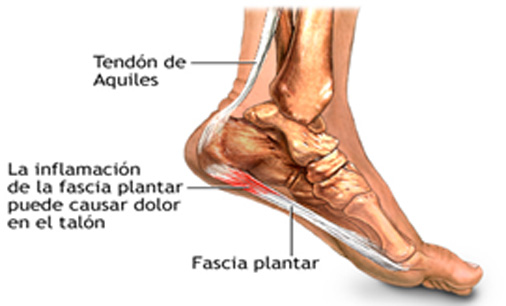 fascitis-plantar