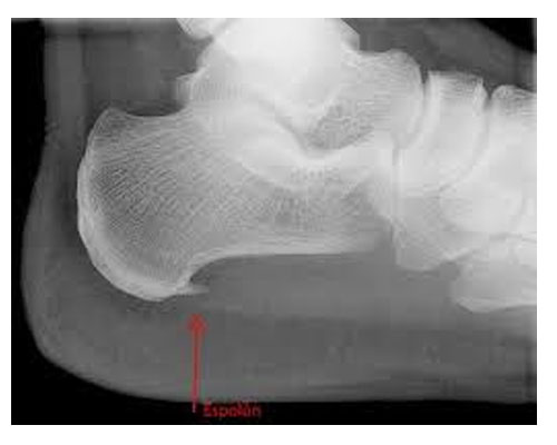 tratamiento-fascitis-plantar