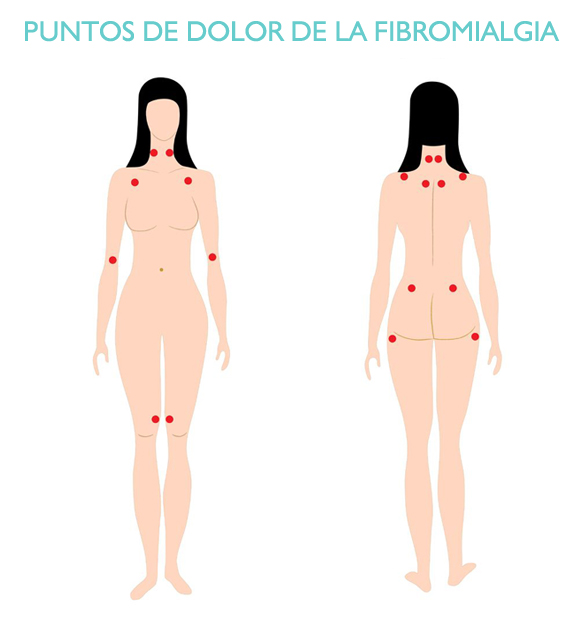 puntos-de-dolor-de-la-fibromialgia-iconica-vigo