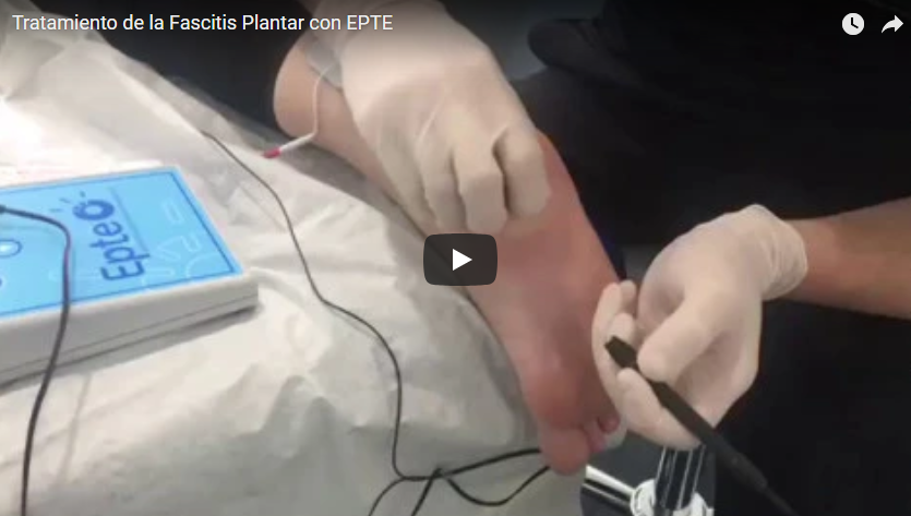 TRATAMIENTO DE LA FASCITIS PLANTAR CON ‘ELECTROLISIS PERCUTÁNEA TERAPÉUTICA’ (EPTE)