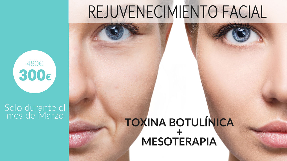 oferta-tratamiento-botox-mesoterapia-vigo