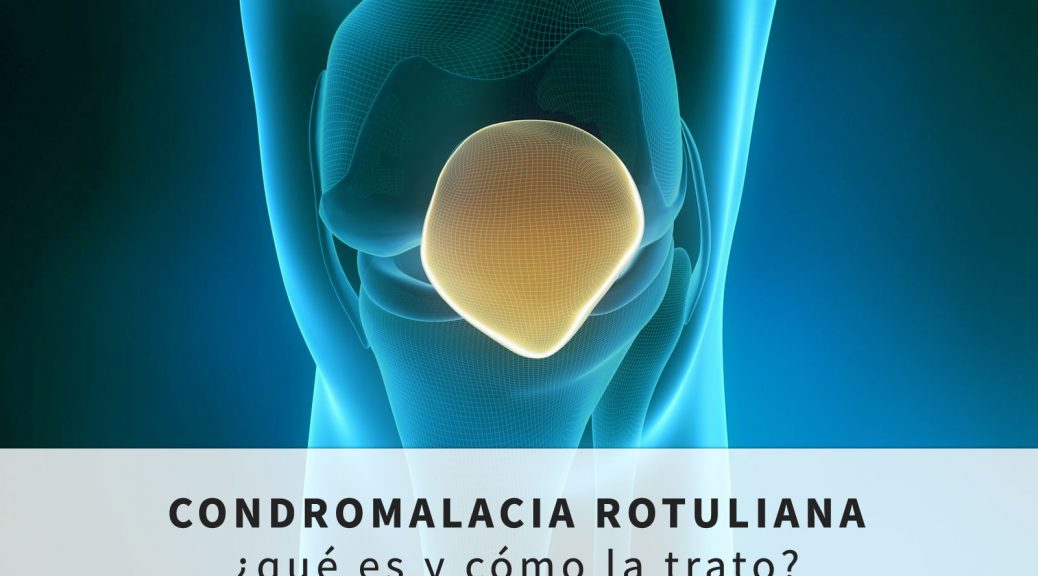 Condromalacia rotuliana: que es y como se trata