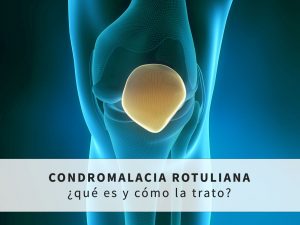 Condromalacia rotuliana: que es y como se trata