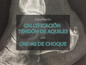 tratamiento-calcificacion-tendon-de-aquiles-con-ondas-de-choque