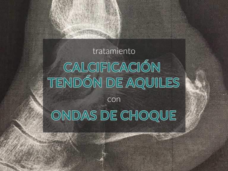 tratamiento-calcificaci-n-tend-n-de-aquiles-con-ondas-de-choque