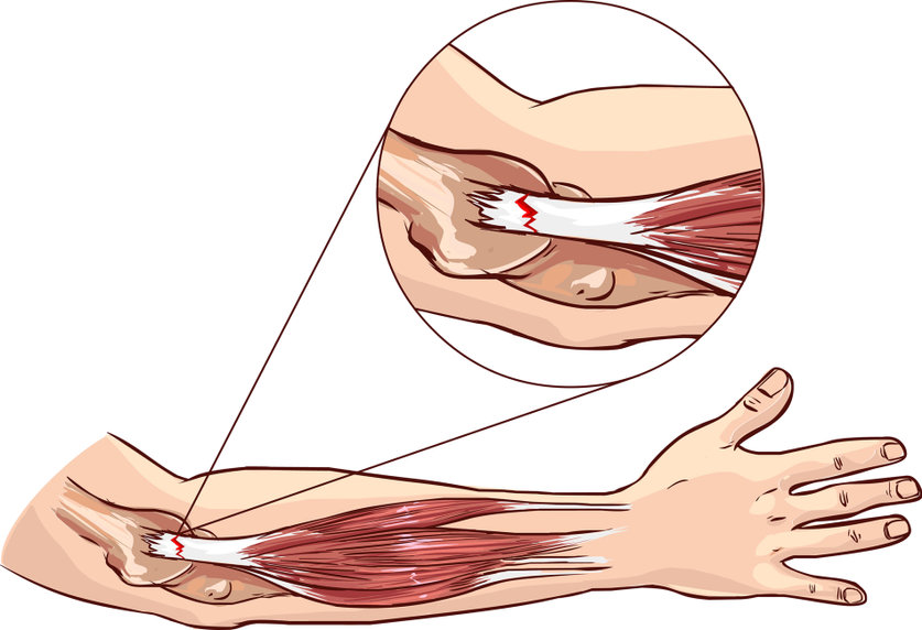 tratamiento-Epicondilitis-y-epitrocleitis