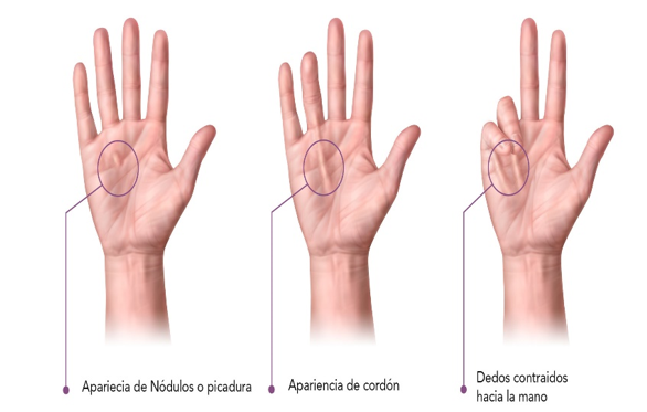 tratamiento enfermedad de dupuytren