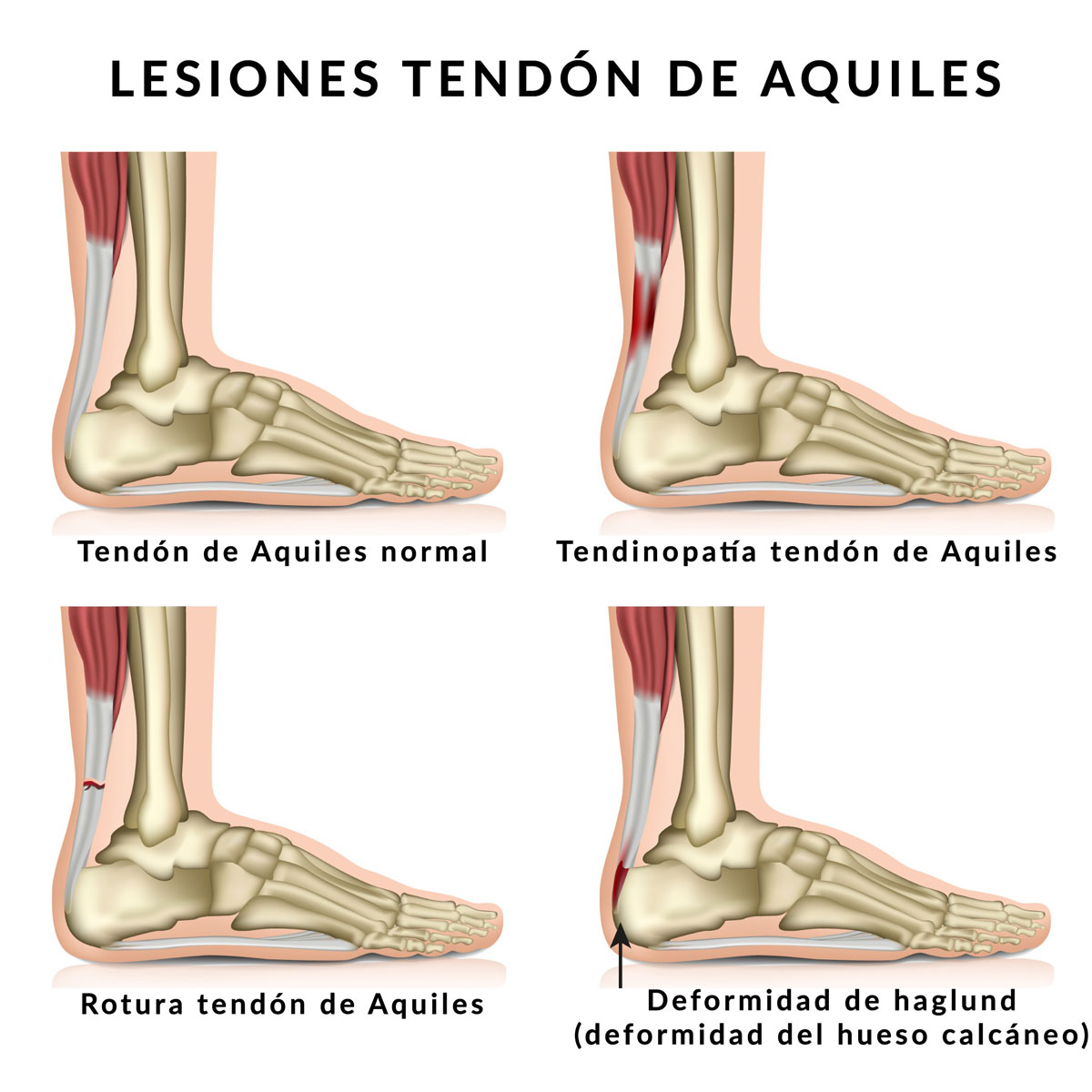 Lesiones del tendón de aquiles