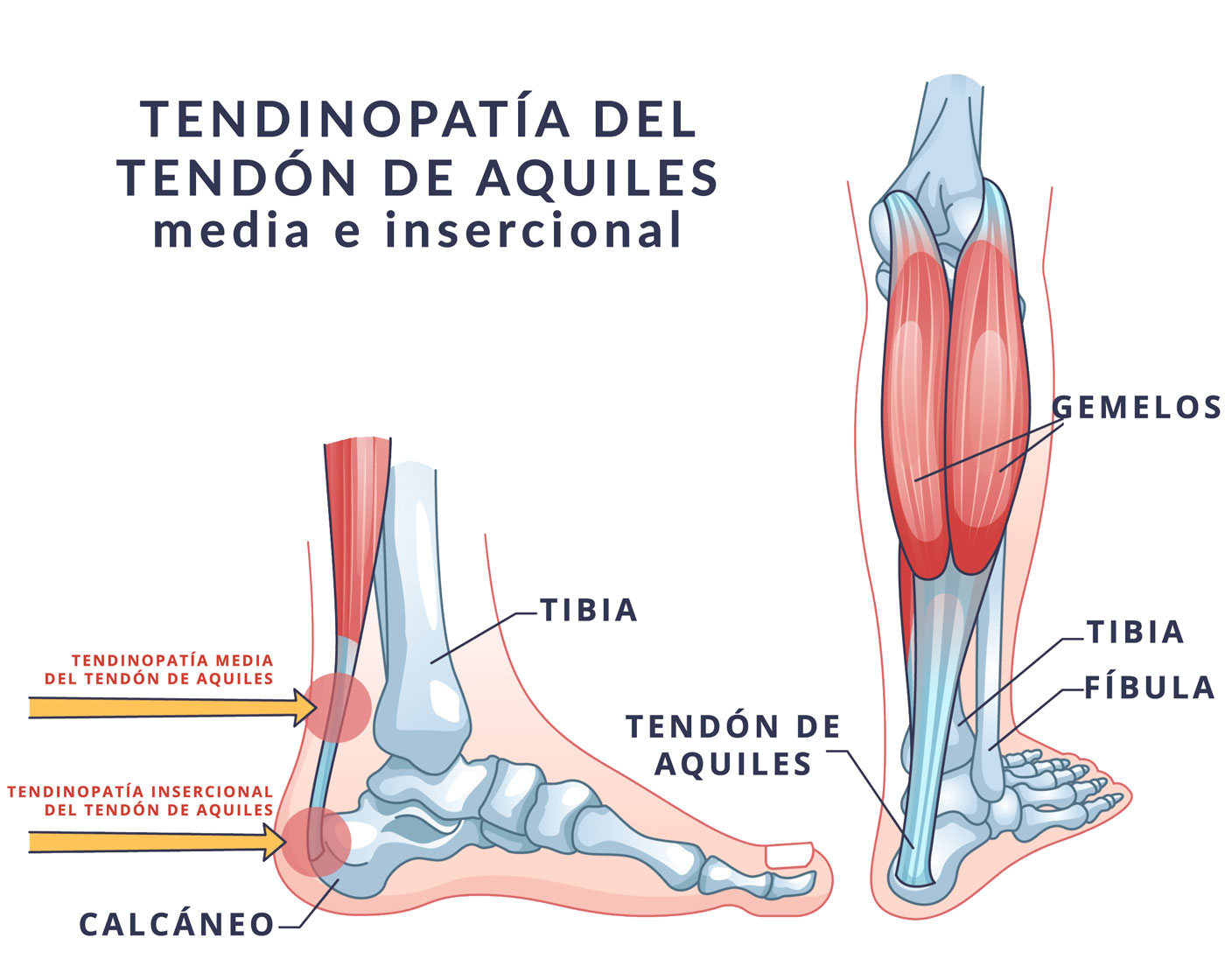 tendinopatia media e insercional del tendon de aquiles