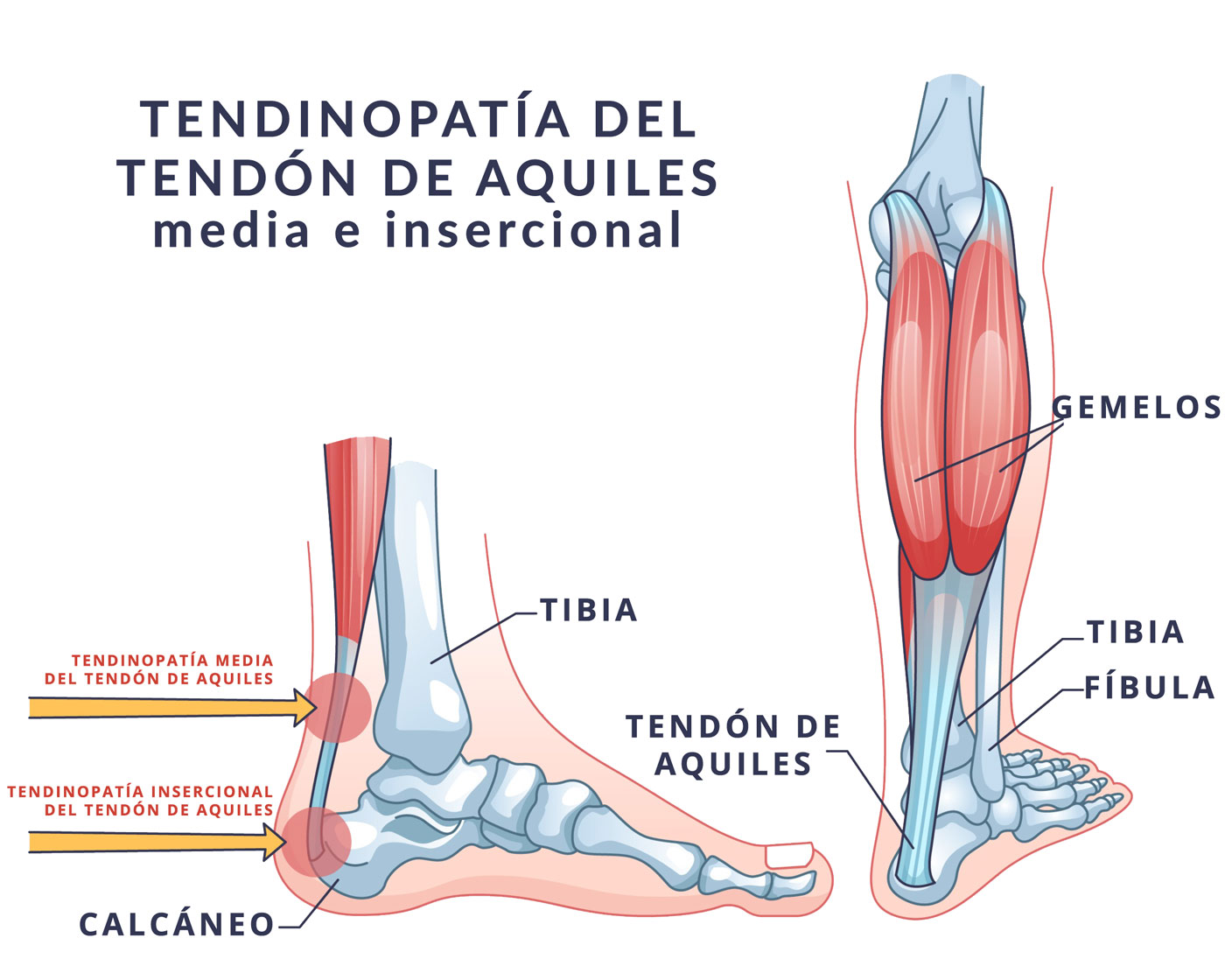 Tendinopatía del tendón de aquiles: qué es y cómo tratarla