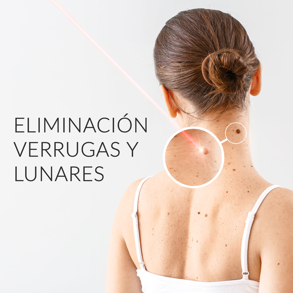 Eliminación de verrugas y lunares con laser